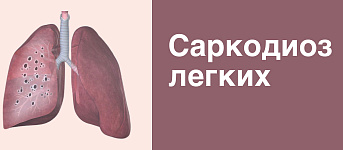 Саркоидоз легких: причины, симптомы, лечение